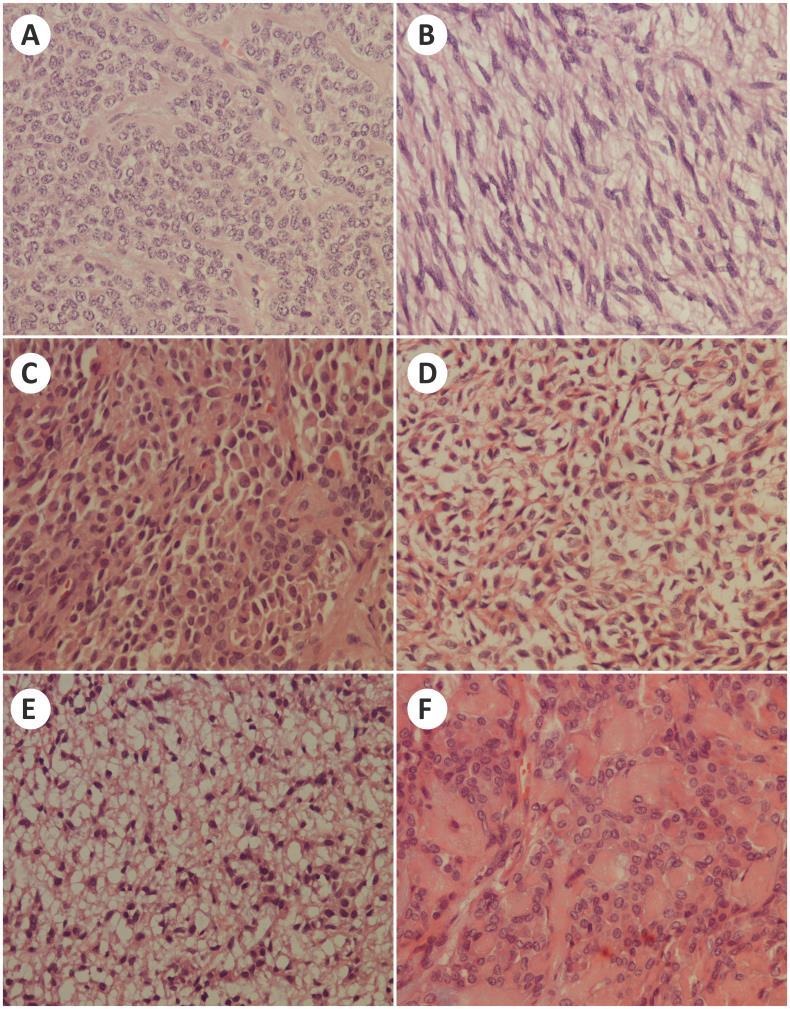 Slika 13. Mioepitelni tumor, A epiteloidni tip, H&E, uveličanje x40; B vretenasti tip, H&E, uveličanje x40; C plazmocitoidni tip, H&E, uveličanje x40; D stelatni tip, H&E, uveličanje.