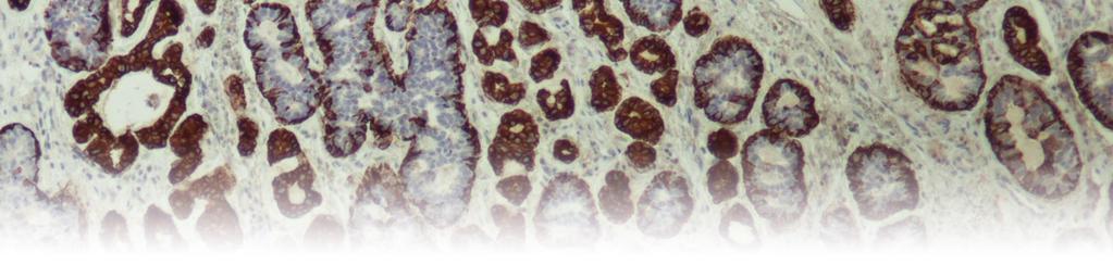 6. DISKUSIJA Tumori pljuvačnih žlezda predstavljaju veoma heterogenu grupu neoplazmi, koje su izgrađene od različitih masa tumorskih ćelija i stromom promenljivih karakteristika.