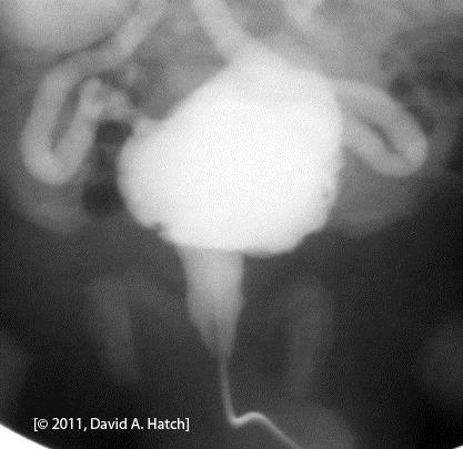 Voiding Phase This film shows a boy with a congenital urethral obstruction.