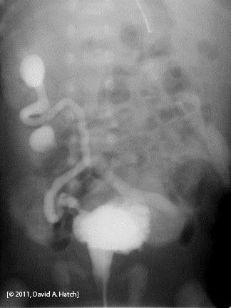 Read the Filling Phase Bilateral reflux Blunted calyces Tortuous ureters (grade V) Urethra Wider