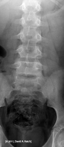 Here is a spine from a normal KUB or scout film.