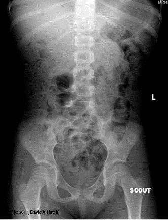 Read This Scout Film The bones are normal What about soft tissues (bowel, etc.)?