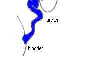 VESICOURETERAL REFLUX Grading V Gross dilatation & tortuosity of ureter; gross dilatation