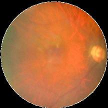 Stages of Retinopathy No referral Your screening results may say either of the following: No retinopathy (yearly recall) Background retinopathy (yearly recall) Referral Pre-proliferative retinopathy