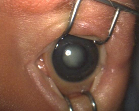 Ocular Abnormalities