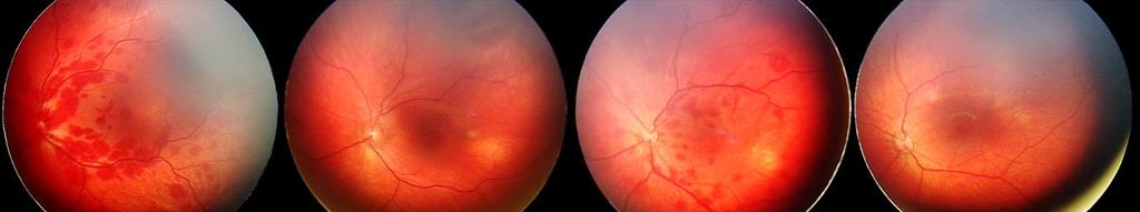 Retinal Haemorrhages Forty-two infants