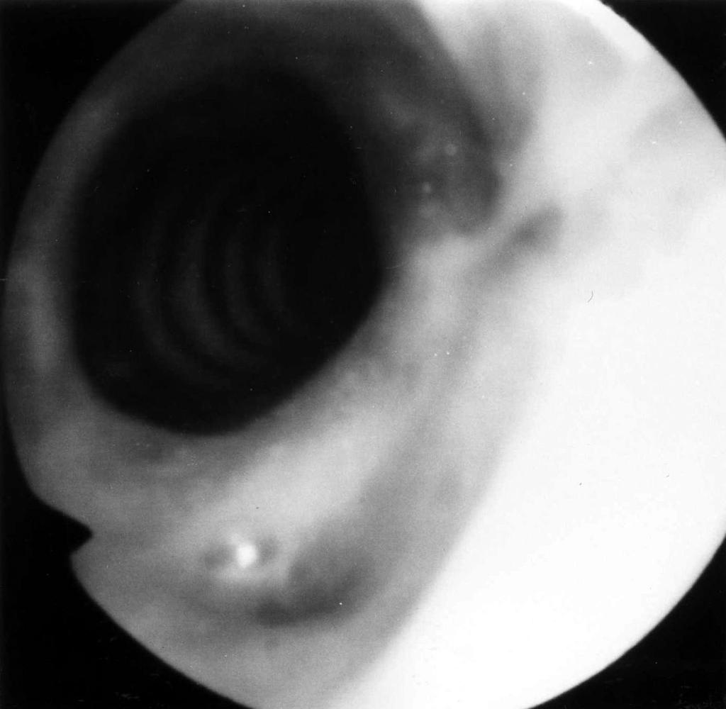 Laser Surgery in Subglottic Stenosis & Wegener Disease Fig. 4. Tracheoscopic image of postoperative subglottic stenosis. tissue.