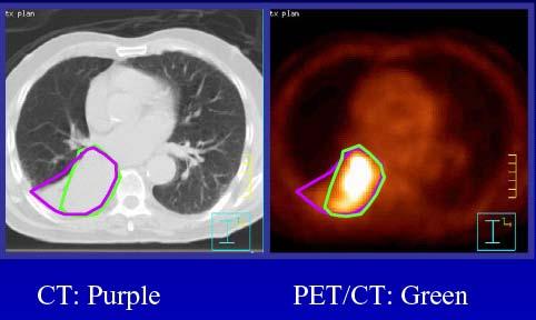 PET-CT-based images GTV FDG PET-CT  PET may