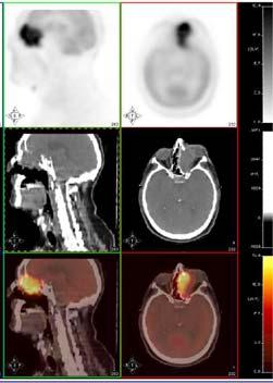 PET/CT and Planning of Radiation Therapy