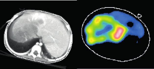 Internal Dosimetry Task Force Report Treatment Planning For Molecular Radiotherapy: Potential And Prospects CT and I-123 SPECT of neuroblastoma References 1. Wieland DM, Wu J, Brown LE, et al.