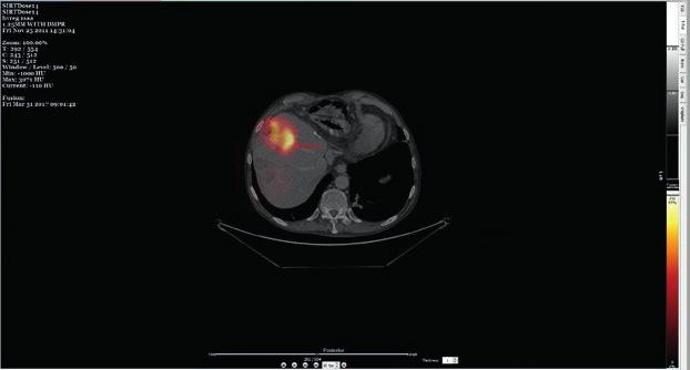 Treatment Planning For Molecular Radiotherapy: Potential And Prospects Internal Dosimetry Task Force Report DOSIMETRY-BASED TREATMENT PLANNING With current recommendations dosimetry is often used as