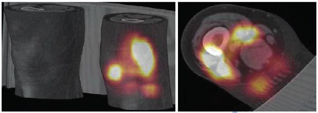 Treatment Planning For Molecular Radiotherapy: Potential And Prospects Internal Dosimetry Task Force Report Example of intra-articular distribution of Y-90 citrate after injection into a knee of a