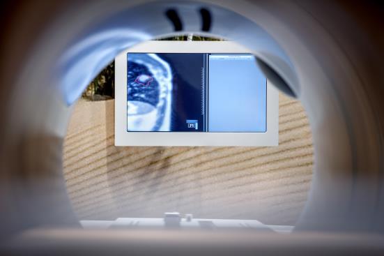 MRI-guided SABR (daily