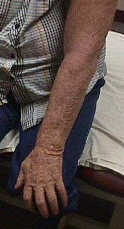 Over time, the limb will become larger. Lymphedema is usually not bilateral.