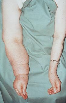 Characteristics of Lymphedema Lymphedema is bilaterally asymmetric. This means that the two limbs will look different, even if two limbs are affected. Lymphedema is pitting edema.