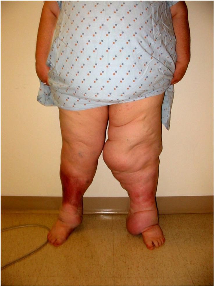 Characteristics of Lymphedema In lymphedema, cellulitis infection is common. With cellulitis there is heat, redness, pain and the patient feels sick, as though they have the flu.