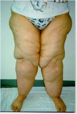 Characteristics of Lipedema Lipedemais a chronic disease of fat distribution. The body is large from the hips down.