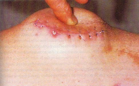Unlike lymphedema, onset of swelling will be associated with a traumatic event such as injury or surgery.