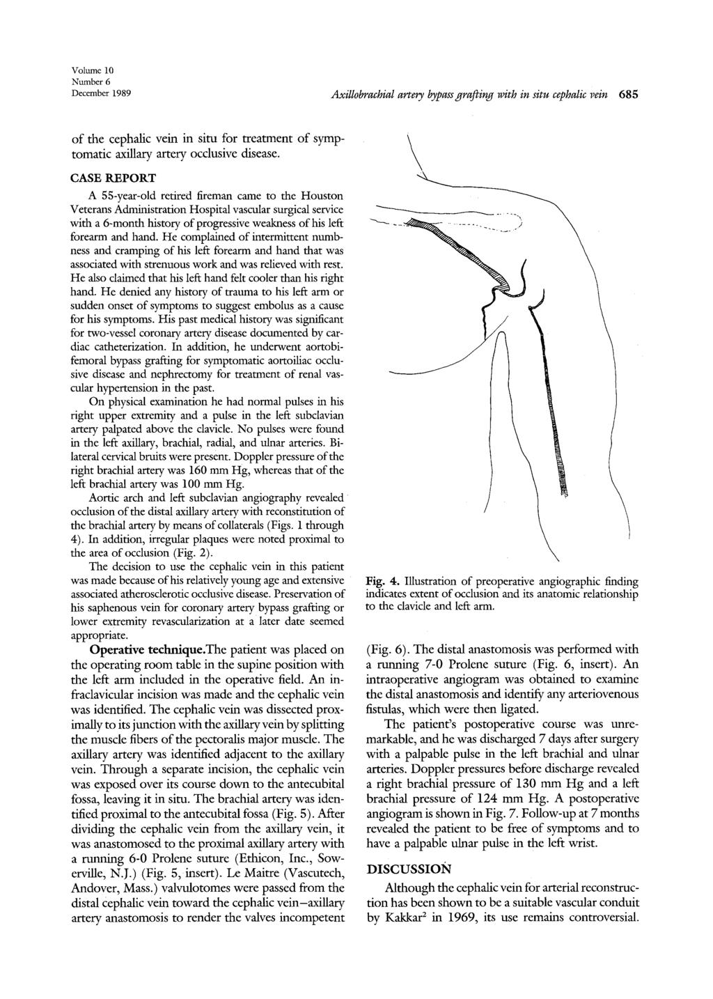 Volume 10 Number 6 December 1989 Axillobrachial artery bypass grafting with in situ cephalic vein 685 of the cephalic vein in situ for treatment of symptomatic axillary artery occlusive disease.