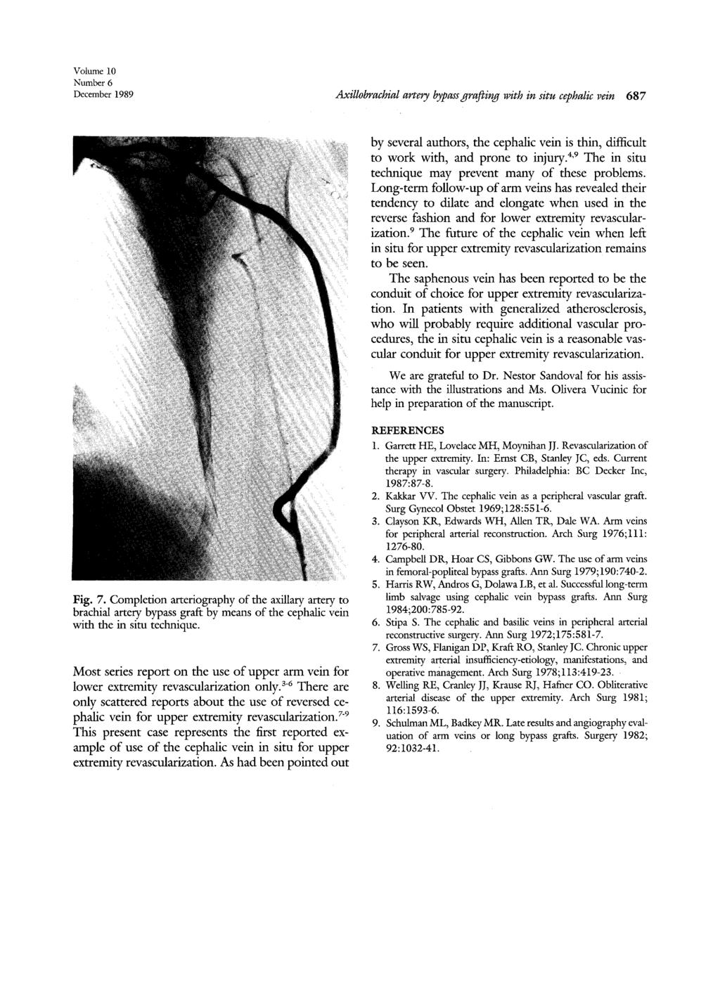 Volume 10 Number 6 December 1989 Axillobrachial artery bypass grafting with in situ cephalic vein 687 by several authors, the cephalic vein is thin, difficult to work with, and prone to injury.