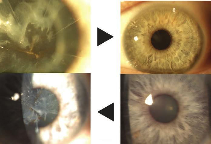 64 In Practice Figure 2. An illustration of RK in eyes that have undergone multiple surgeries, including pseudophakic and phakic IOL implantation.