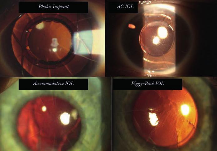 The most important step of all comes next: refraction-based laser corneoplastique.