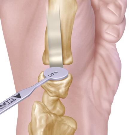 (See Surgical Pearl below.) Using a sagittal saw, place the blade in the slot of the Vertical Cutting Guide to make a vertical cut in the metacarpal.