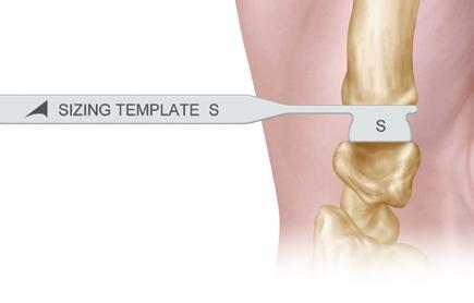 Figure 2D Figure 2E Surgical Pearl: Depending on the amount of subluxation/bony erosion more or less bone may need to be removed (3-5 mm).