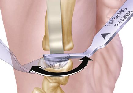 The trapezial cup may be safely deepened to a level equal with the distal third of the trapezium. Use continuous irrigation when preparing the trapezium. A.