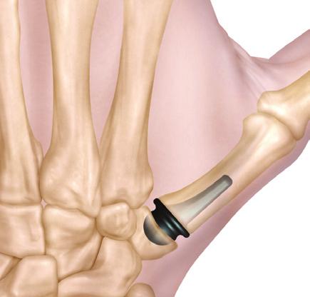Lightly impact the implant with the impactor provided and reduce the joint. Figure 8A Check passive thumb adduction combined with MP and IP flexion.