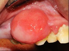 peripheral odontogenic fibroma of maxillary anterior region.