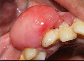 This swelling was initially very small and has grown to present size within a period of 10 months.