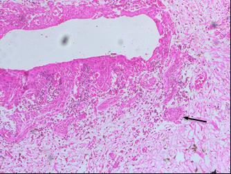 Figure No.4a: Photomicrograph of lesion showing inflamed fibrous connective tissue with island of odontogenic epithelium.(h & E, 4x). Figure No.