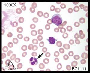 has minimal clumping, and stains a lighter purple or pink. Image BCI-11 is a segmented neutrophil. Neutrophils typically have 2 to 5 nuclear lobes connected by thin strands of chromatin.
