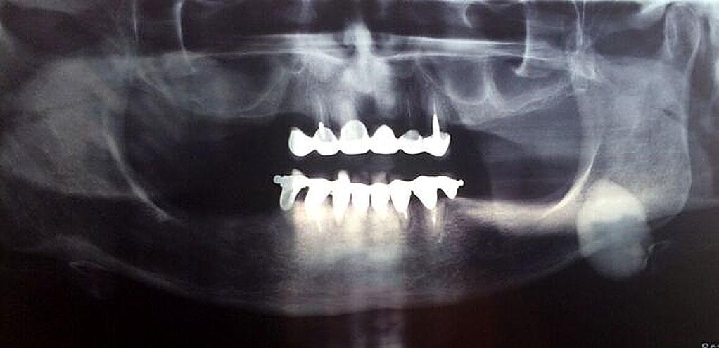 A 68-year-old woman came to the department of Oral and Maxillofacial Surgery of Faculty of Dental medicine, Medical University- Sofia for evaluation of a swelling in the left side of mandible which