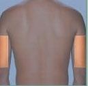 Abdomen Upper Thighs Upper Arms About the Safety Syringe There are two different-sized safety syringes, a 3 cc/ml (large) syringe and a 1 cc/ml (small) syringe Before using the