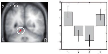 In particular, significant increases in task-related coupling ON medication compared to OFF were found between the left caudate nucleus and prefrontal regions, including the left middle frontal gyrus