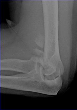 TEA FOR DISTAL HUMERUS FRACTURES More rapid return of function