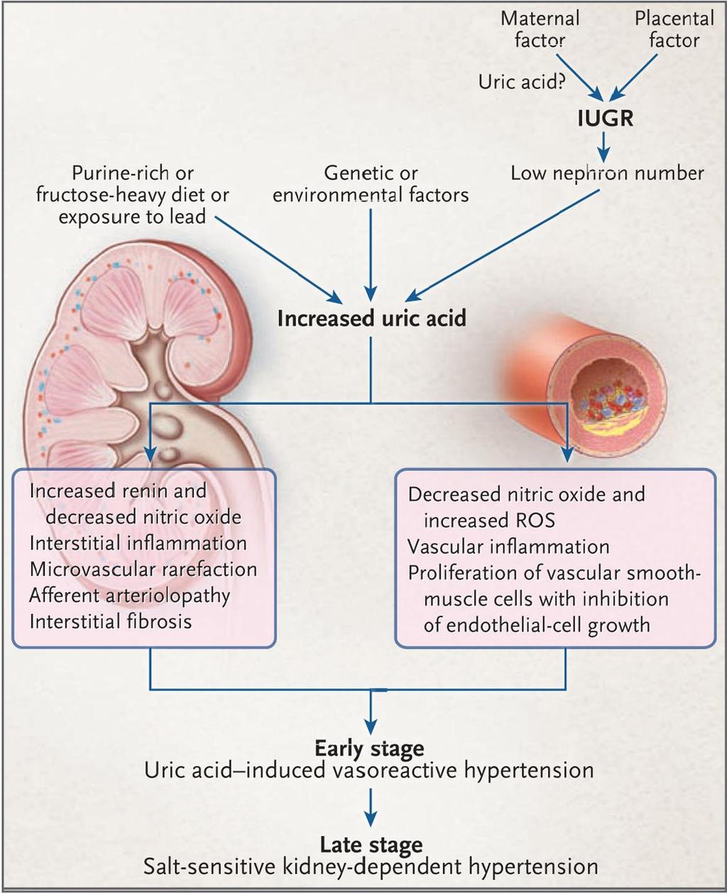 Uric acid mediated hypertension Feig
