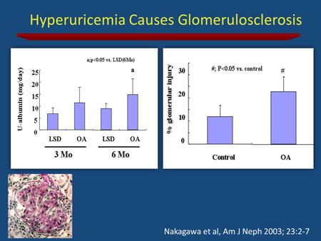 Another study from the USA showed that high uric acid also causes glomerular hypertrophy
