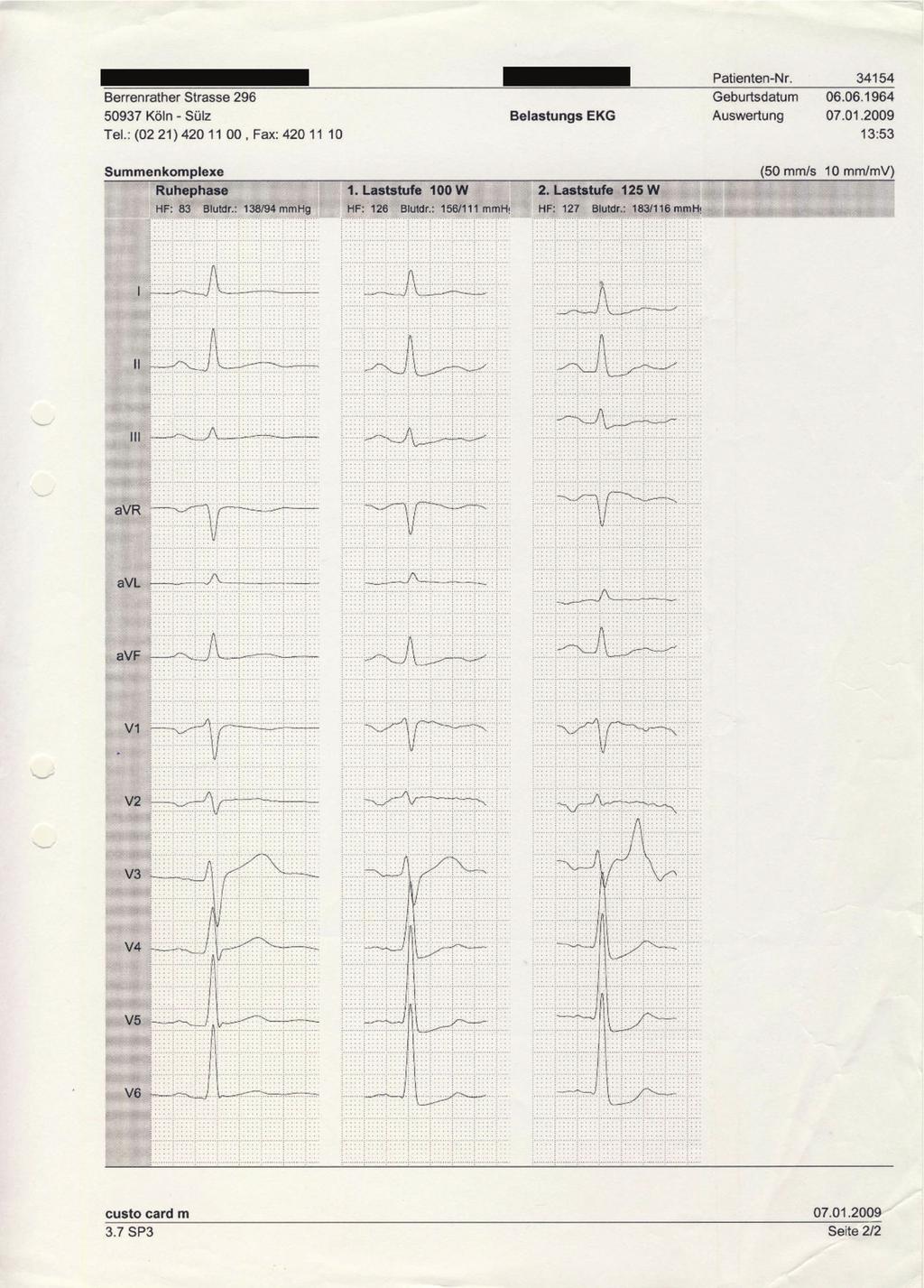 2 International Vascular Medicine Figure 1: 12-lead electrocardiogram demonstrating significant ST-depression in the posterior leads during exercise.
