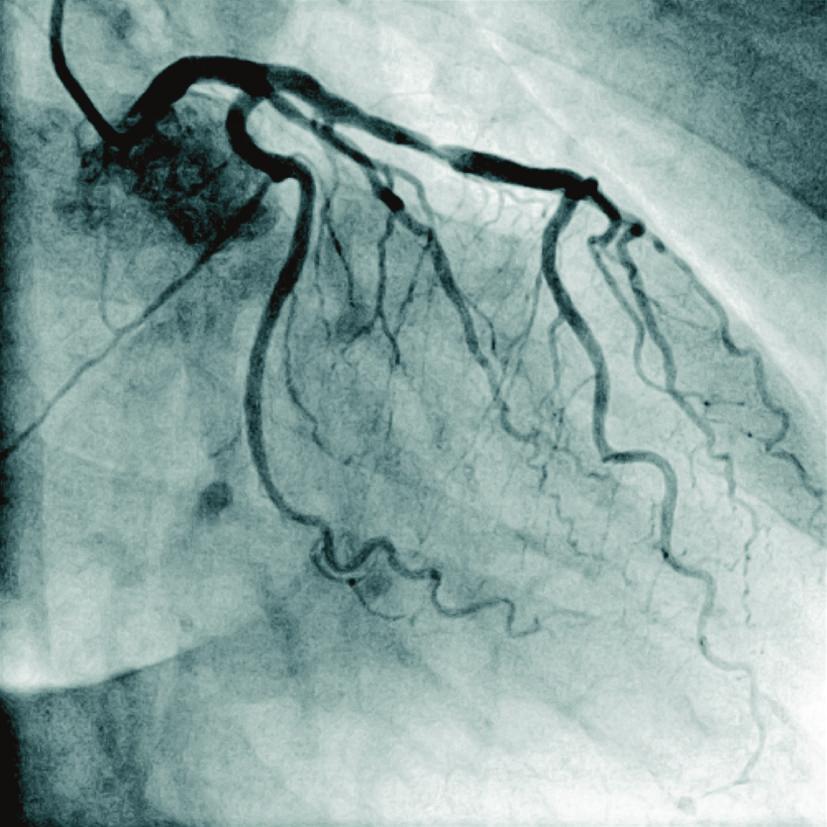 International Vascular Medicine Figure 2: Left coronary artery (RAO 31, caudal 0,4).