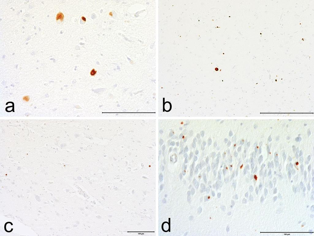 Acta Neuropathol (2016) 131:75 86 81 Fig. 4 ptdp-43 pathology in CTE. a ptdp-43 neuronal inclusions in the amygdala. b p-tdp-43 inclusions and dot-like neurites in CA1.