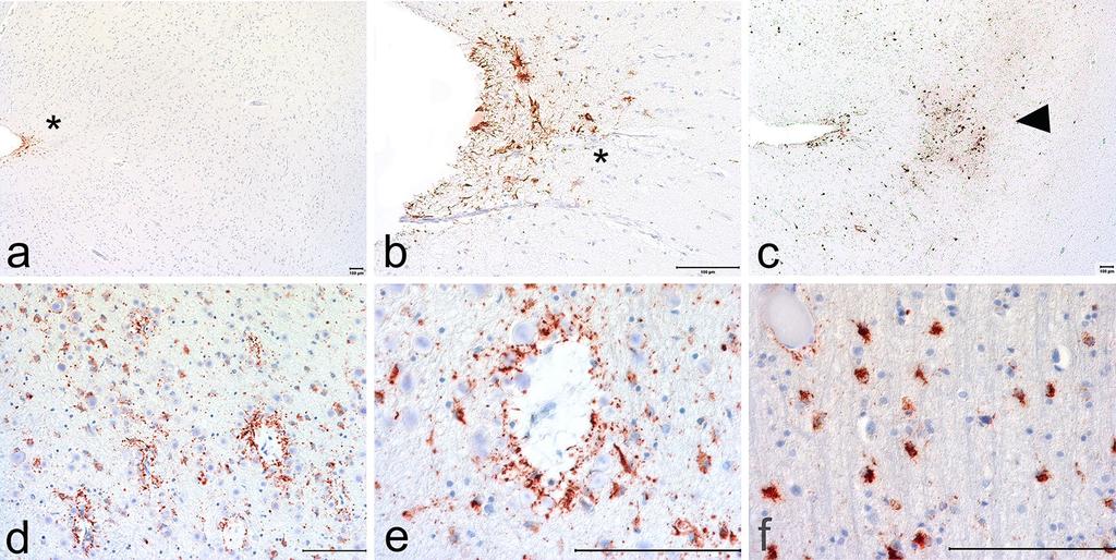 82 Acta Neuropathol (2016) 131:75 86 Fig. 5 Age-related p-tau astrogliopathy that may be present. a and b.