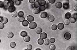 Figure 1: Red blood cells observed on high power microscopy of urine sediment.