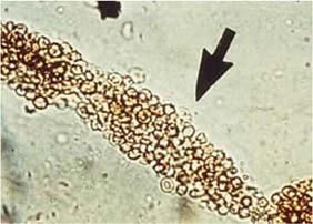 The presence of red cell casts (Figure 4) in the urinary sediment is strong evidence for glomerular hematuria. Figure 4: Example of a red cell cast (arrow) in the urinary sediment.