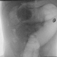 Intussusception Air contrast enema Emergence of Ultrasound Guided