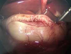 Complications: unrecognized perforation, incomplete myotomy (rare, difficult to diagnose),