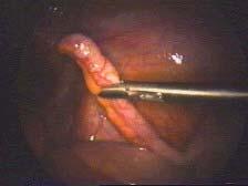 Appendicitis perforated with