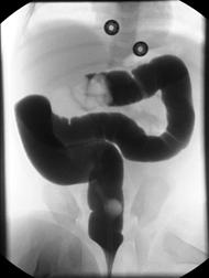 Intussusception Evaluation If